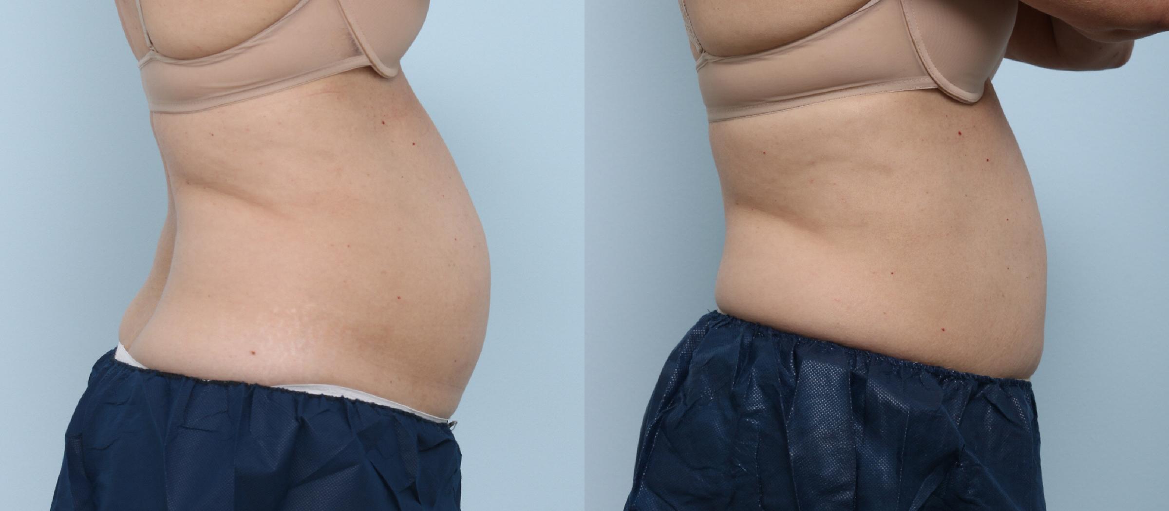  before and after pictures in , , Your CoolSculpting Questions Answered