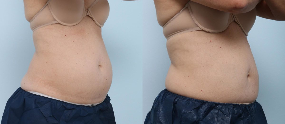  before and after pictures in , , Dual CoolSculpting in Houston, TX