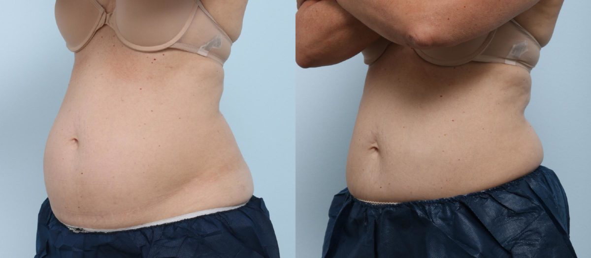 Coolsculpting before and after pictures in Houston, TX, Patient 763