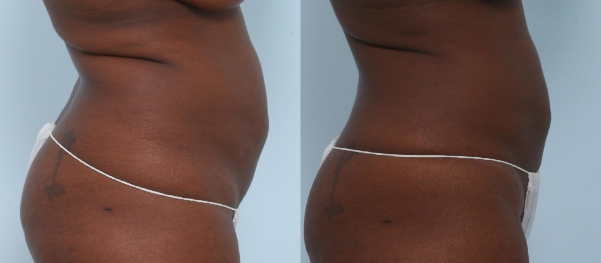 Coolsculpting before and after pictures in Houston, TX, Patient 776