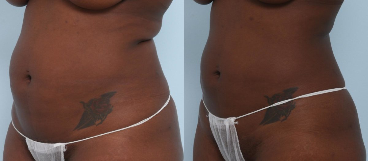 Coolsculpting before and after pictures in Houston, TX, Patient 776