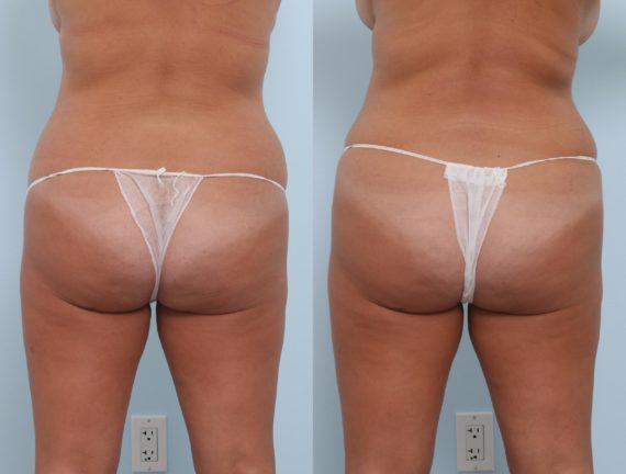 Coolsculpting before and after pictures in Houston, TX, Patient 796