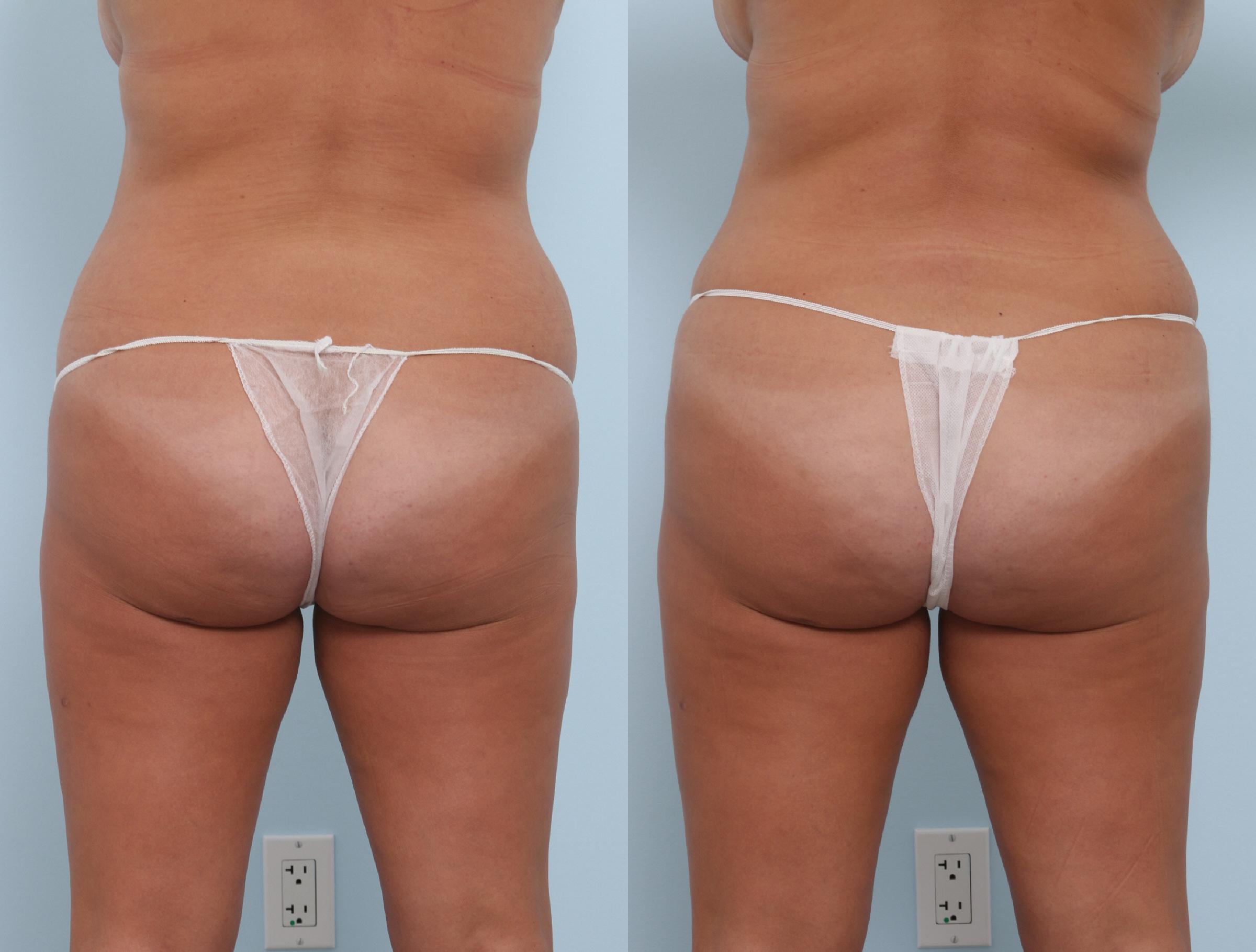  before and after pictures in , , Four Common Problem Areas That are Perfect for CoolSculpting