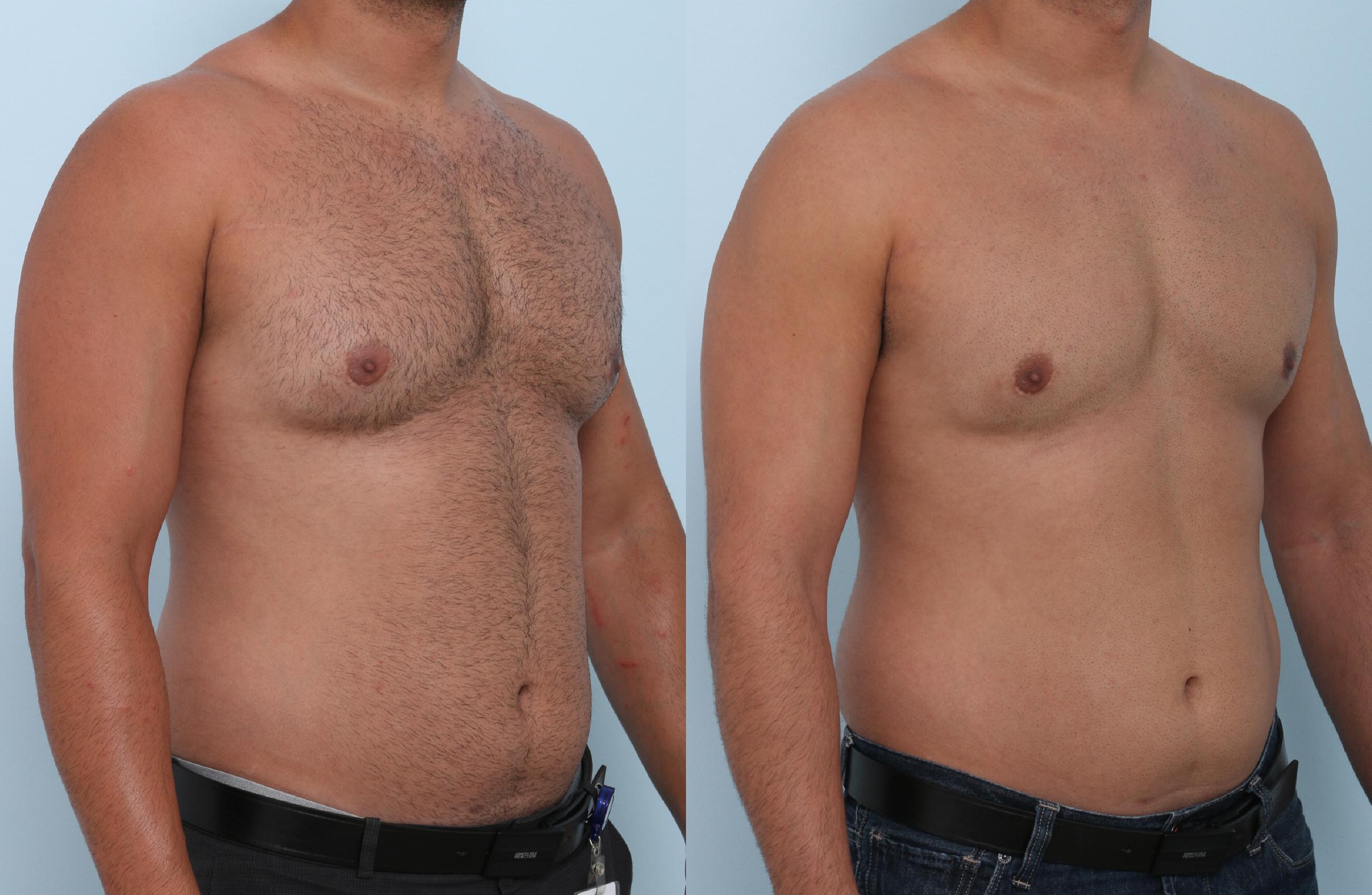 Cool Sculpting Before And After Pics