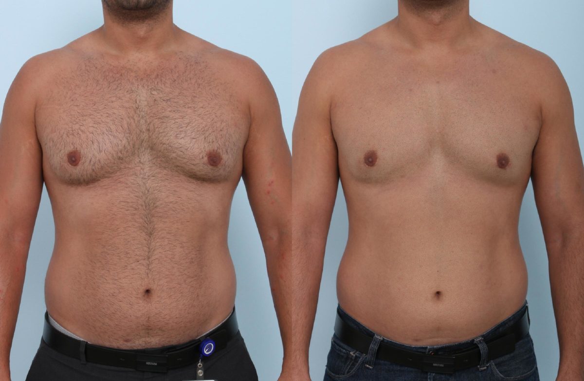  before and after pictures in , , CoolSculpting for Men in Houston, TX