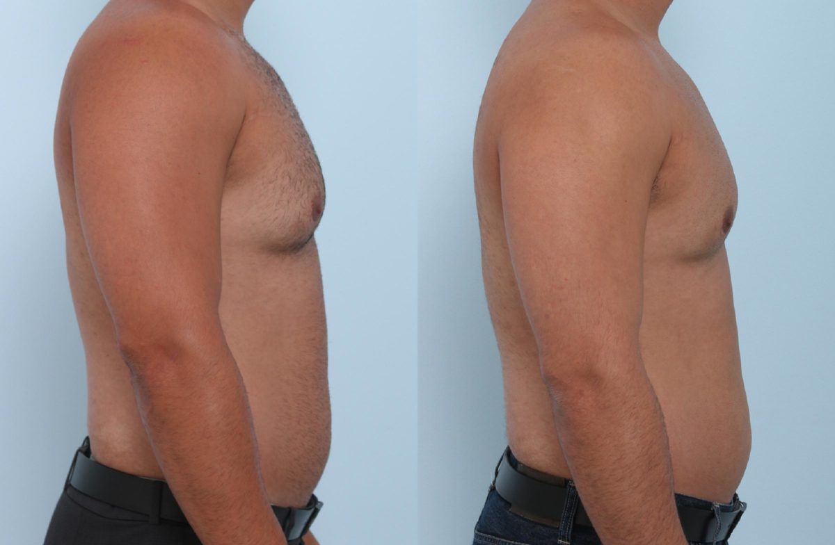 Coolsculpting before and after pictures in Houston, TX, Patient 804