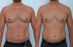 Coolsculpting before and after pictures in Houston, TX, Patient 804