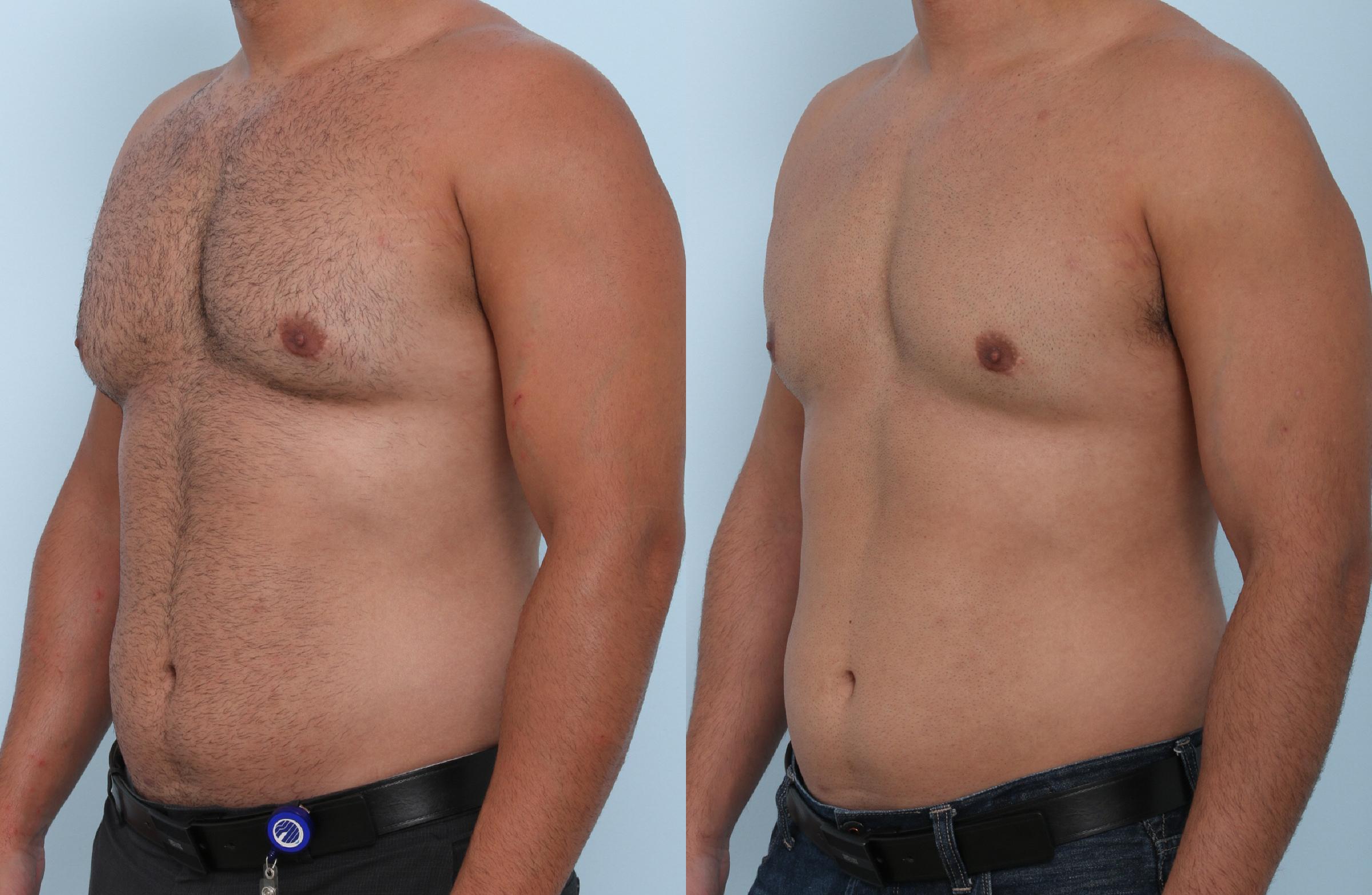 Cool Sculpting Before And After Pics