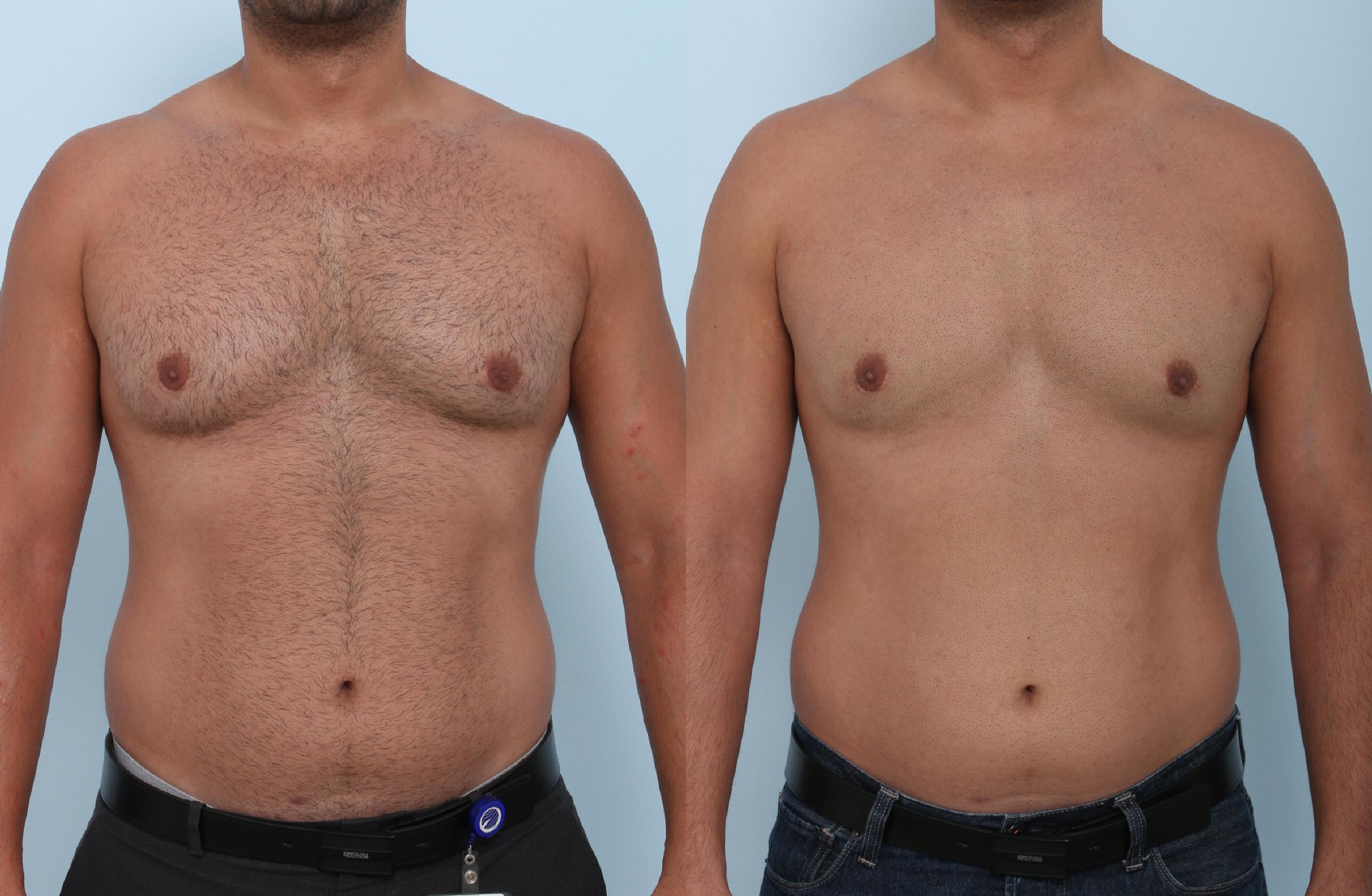  before and after pictures in , , The Truth Behind the Five Most Common CoolSculpting Myths
