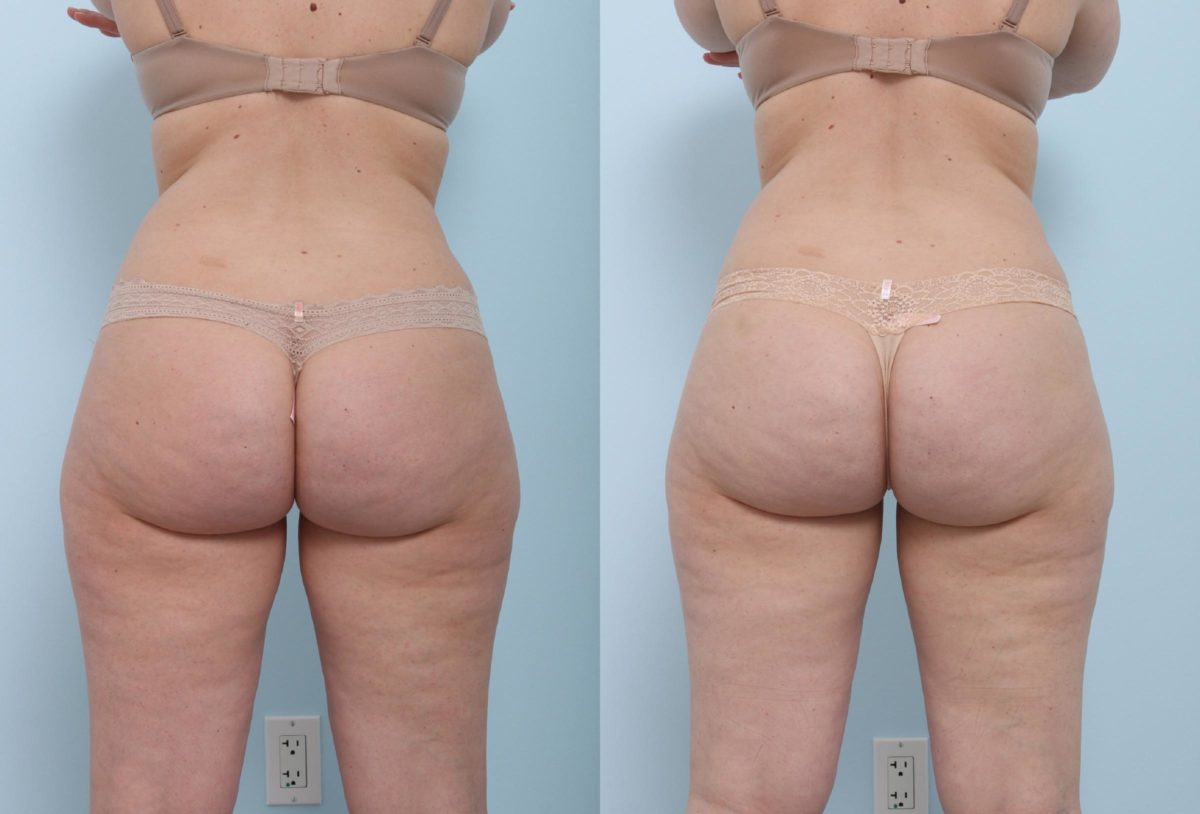 Coolsculpting before and after pictures in Houston, TX, Patient 820