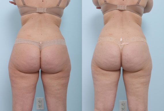 Coolsculpting before and after photos in Houston, TX