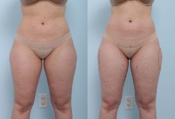 Coolsculpting before and after photos in Houston, TX