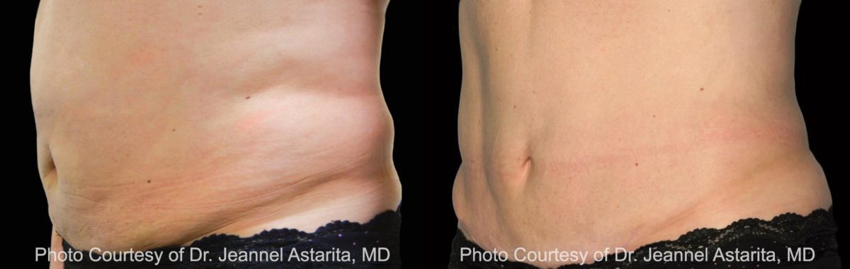 Coolsculpting before and after pictures in Houston, TX, Patient 86