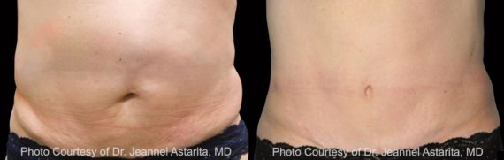 Coolsculpting before and after pictures in Houston, TX, Patient 86
