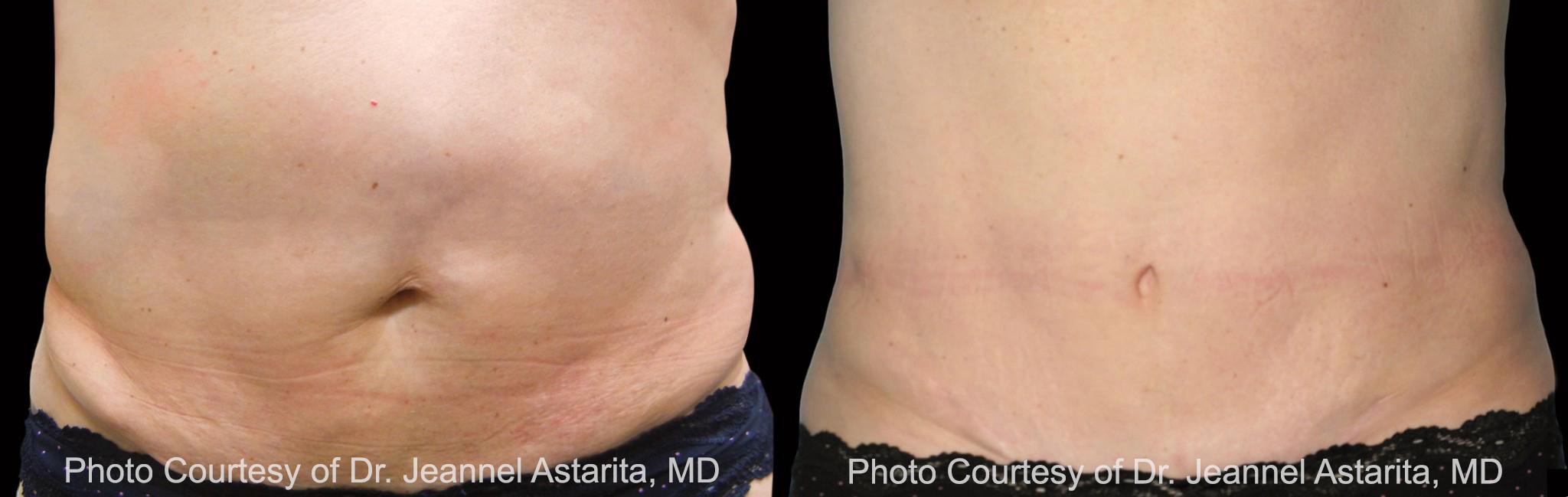  before and after pictures in , , What Happens to Frozen Fat During CoolSculpting?