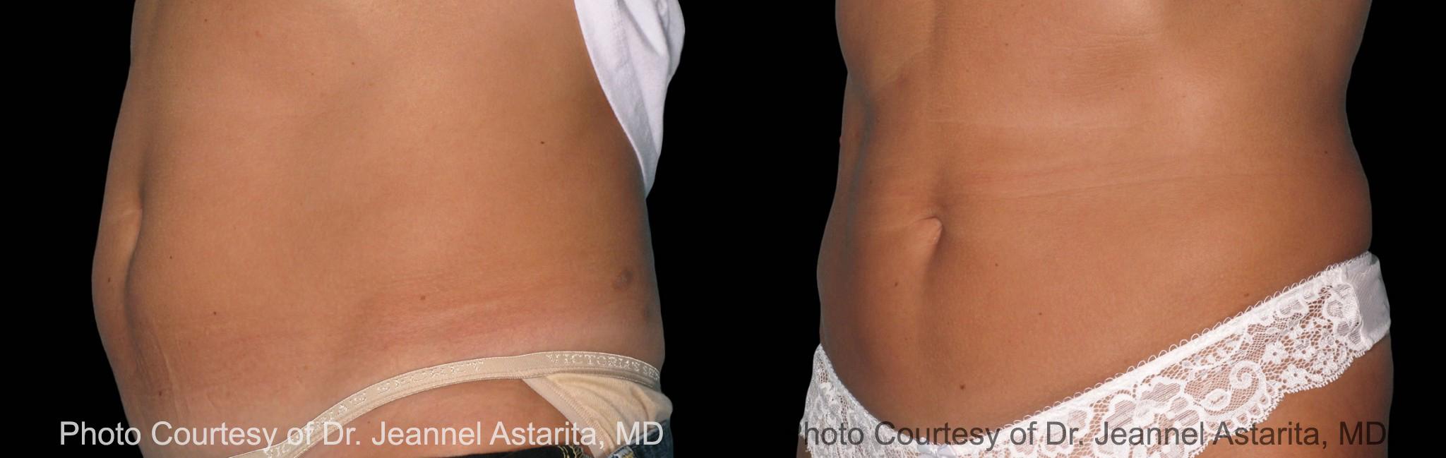  before and after pictures in , , Non-Pinchable Fat? Not a Problem with the CoolSmooth Pro