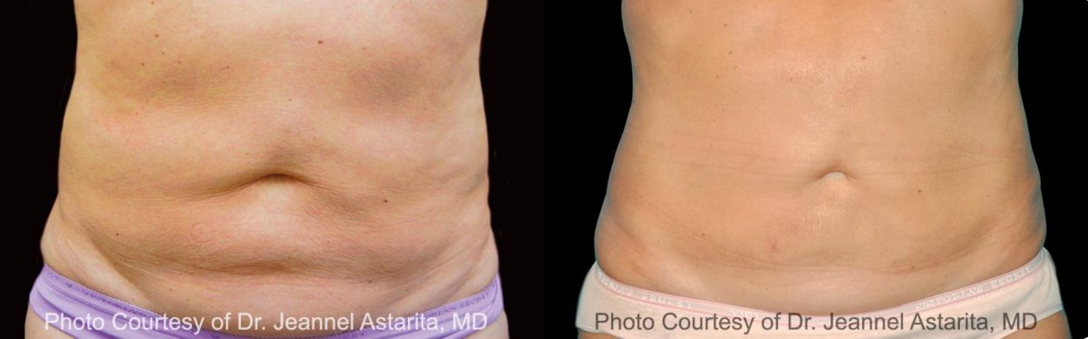 Coolsculpting before and after pictures in Houston, TX, Patient 96
