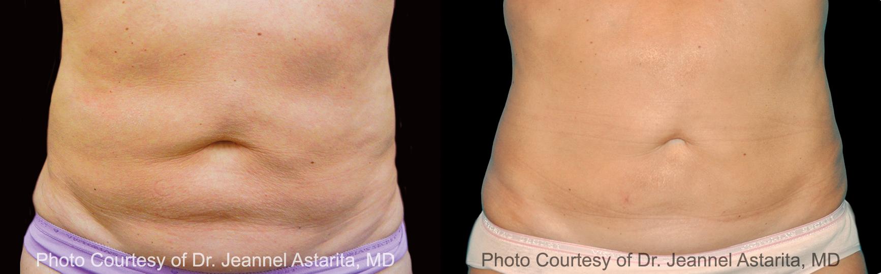  before and after pictures in , , What Happens to Frozen Fat During CoolSculpting?