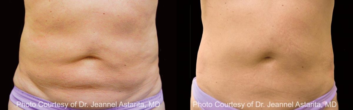 Coolsculpting before and after pictures in Houston, TX, Patient 96